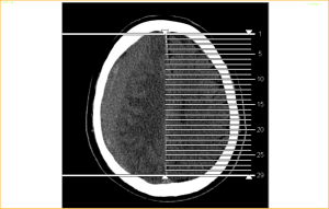 RT Subdural Haemorrhage
